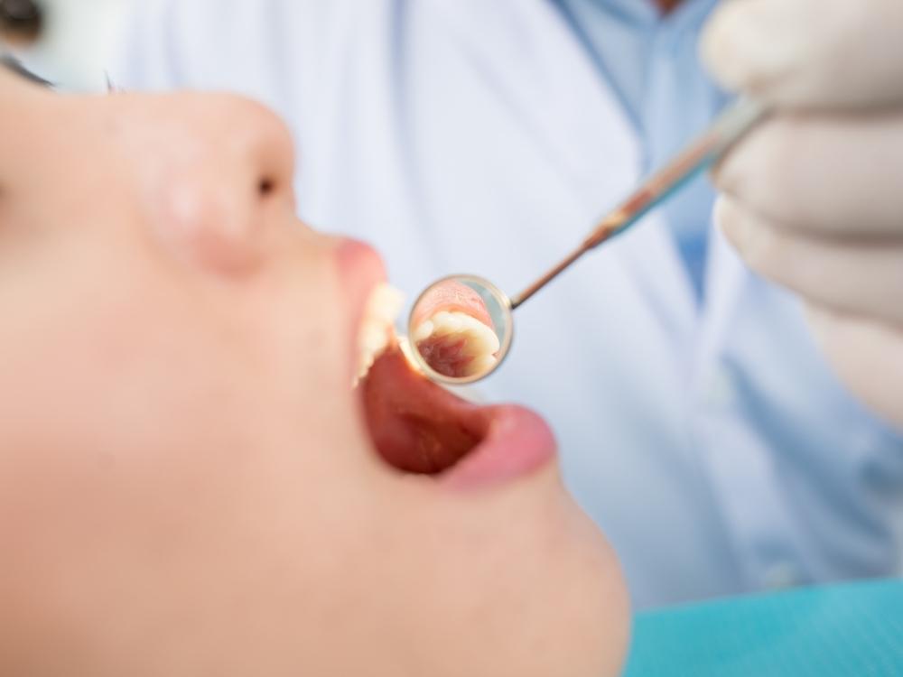 How Long Does It Takes To Fill 3 Cavities Allfitwell