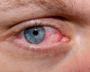 pink eye