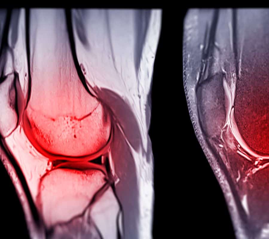When Can I Sleep Without Brace After Acl Surgery How to Sleep After ACL Surgery ? Advice from Orthopedics - Allfit Well