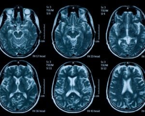 Brain Parenchymal Atrophy
