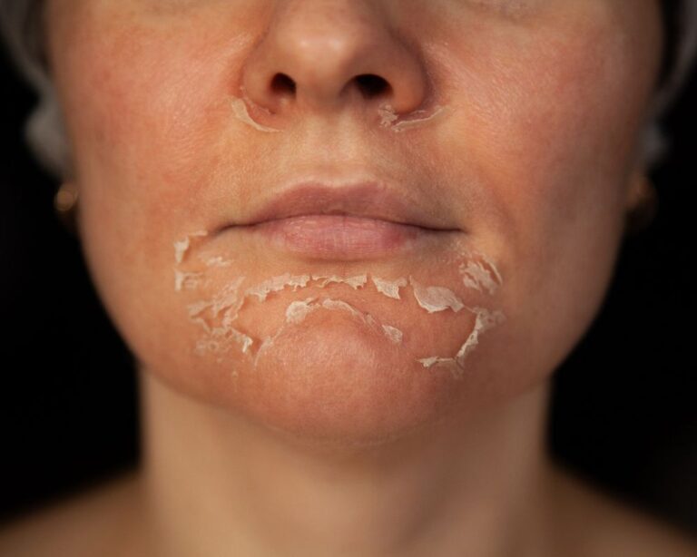 Small Circles of Peeling Skin On