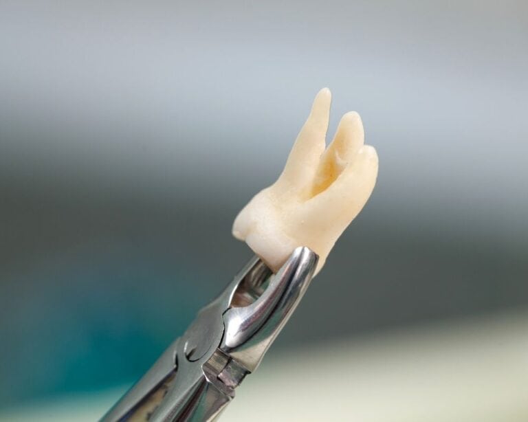 Wisdom Tooth Extraction