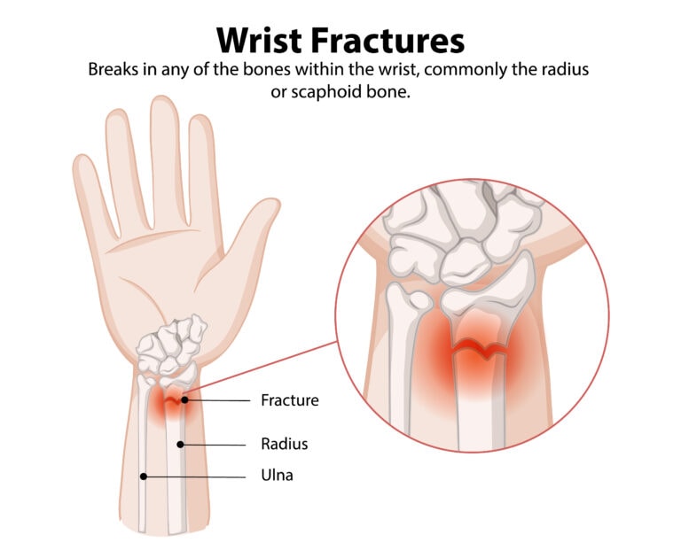 Wrist Fracture