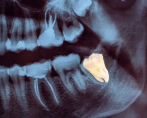 Wisdom Tooth