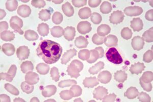 Low Neutrophils and High Lymphocytes: Causes and Implications