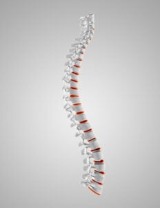 Adhesive Arachnoiditis
