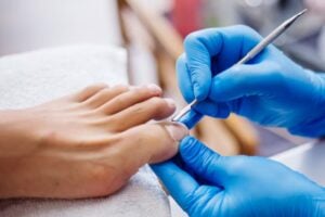 Best Home Remedies for Toenail Fungus