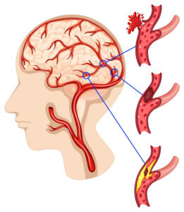 Carotid Body