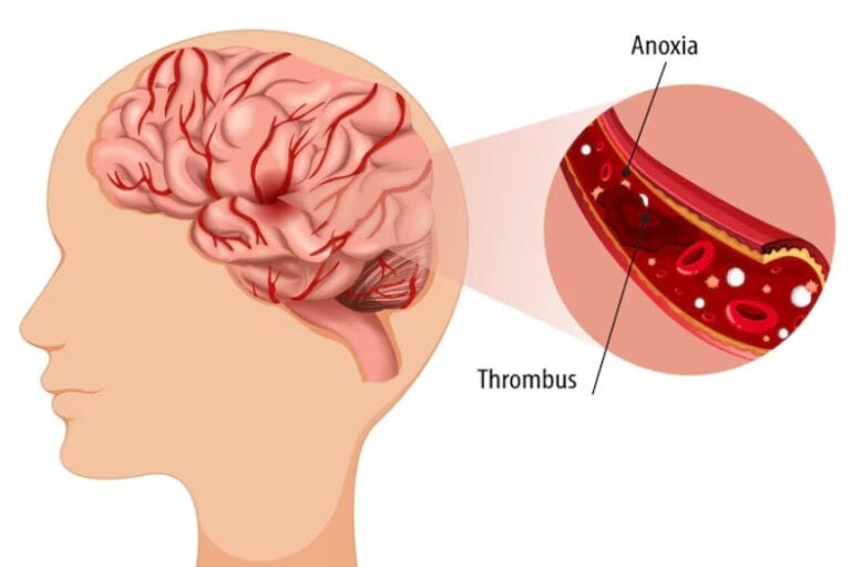 Cerebral Circulation