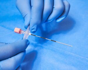 Epidural Lipomatosis