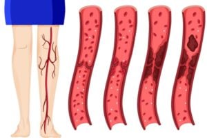 Lower Leg Redness