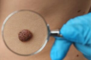 Sebaceous Nevus: Symptoms, Diagnosis, and Treatment Options