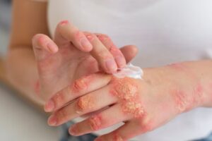 Top Home Remedies for Psoriasis