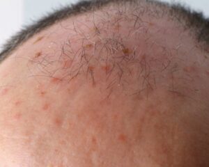 Understanding Hyperkeratosis Parakeratosis