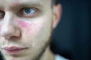 Holistic Approaches to Dermatitis