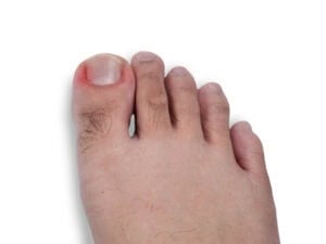 White Spots on Toenails