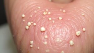 common causes of mouth bumps
