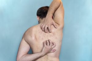 Lichen Sclerosus
