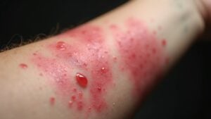 rash caused by external stimuli