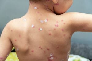 Chickenpox Vs Smallpox