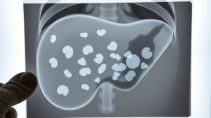gallstones and imaging characteristics