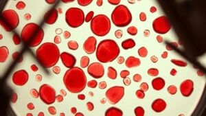 abnormal red blood cells