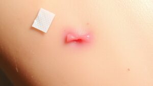 incision healing care guide